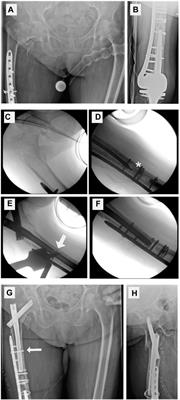 Is nail-plate docking worth the effort? A biomechanical analysis of docking a plate and a nail in peri-implant femur fractures